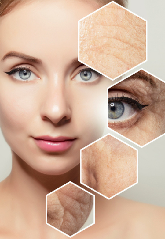 Micro-needling for Acne Scars