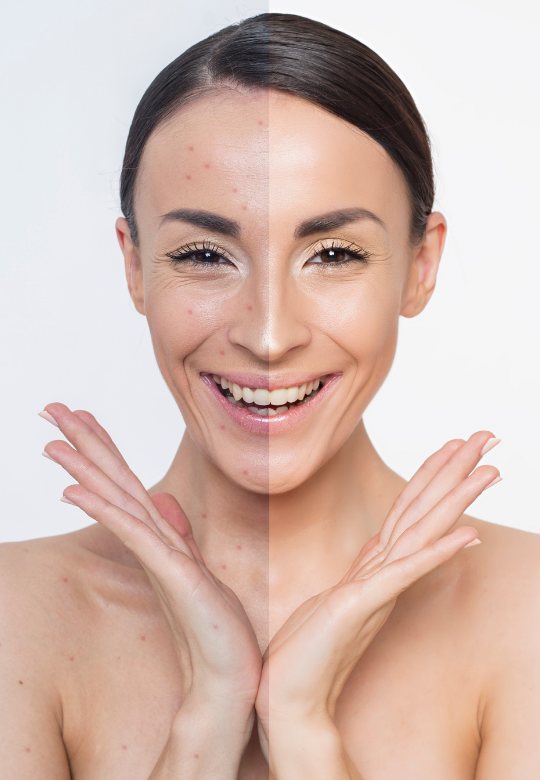 Naturopathic Approach to Acne