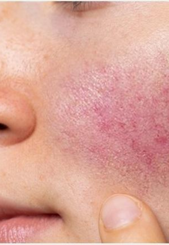 Rosacea - An Inside Out Approach is Needed for Success!